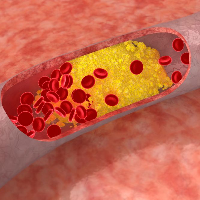 cholesterol build up in artery blocking blood cells