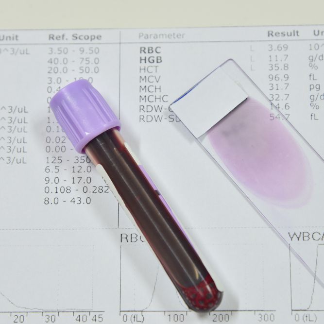 full blood count blood test tube with blood inside on top of blood test result report